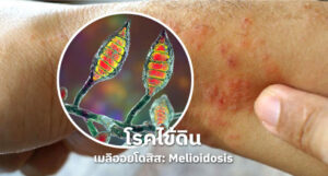 ไข้ดิน